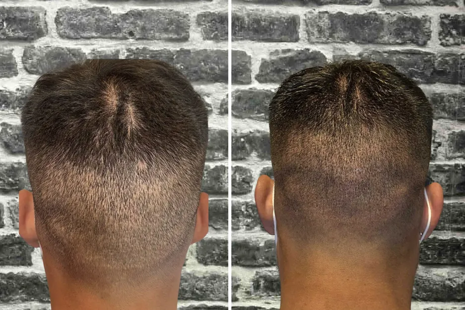 Camouflage de cicatrices